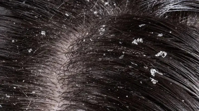 Ketombe Tebal: Penyebab, Cara Mengatasi, dan Tips Biar Rambut Tetap Sehat