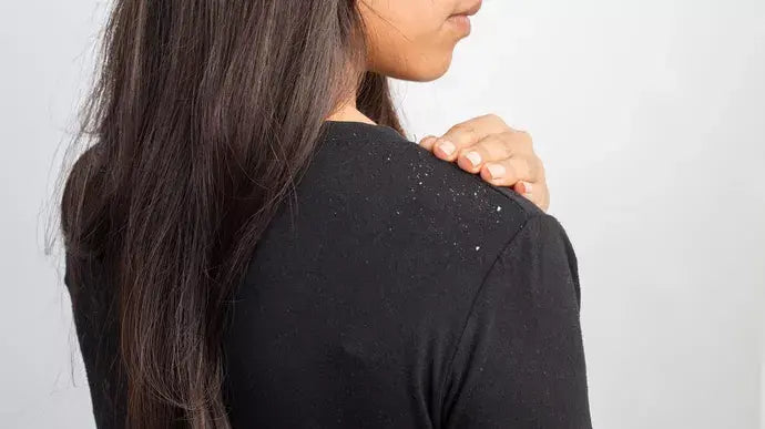 Shampo Anti Ketombe dan Rambut Rontok yang Bagus