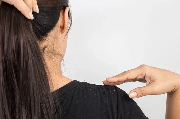 Treatment Ketombe Alami untuk Rambut Lebih Sehat dan Bebas Gatal