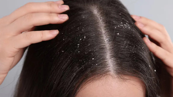 Rambut Berketombe dan Berminyak: Solusi Perawatan Ganda
