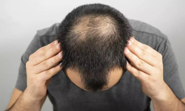 Cara Mengatasi Kebotakan dengan Bahan Alami