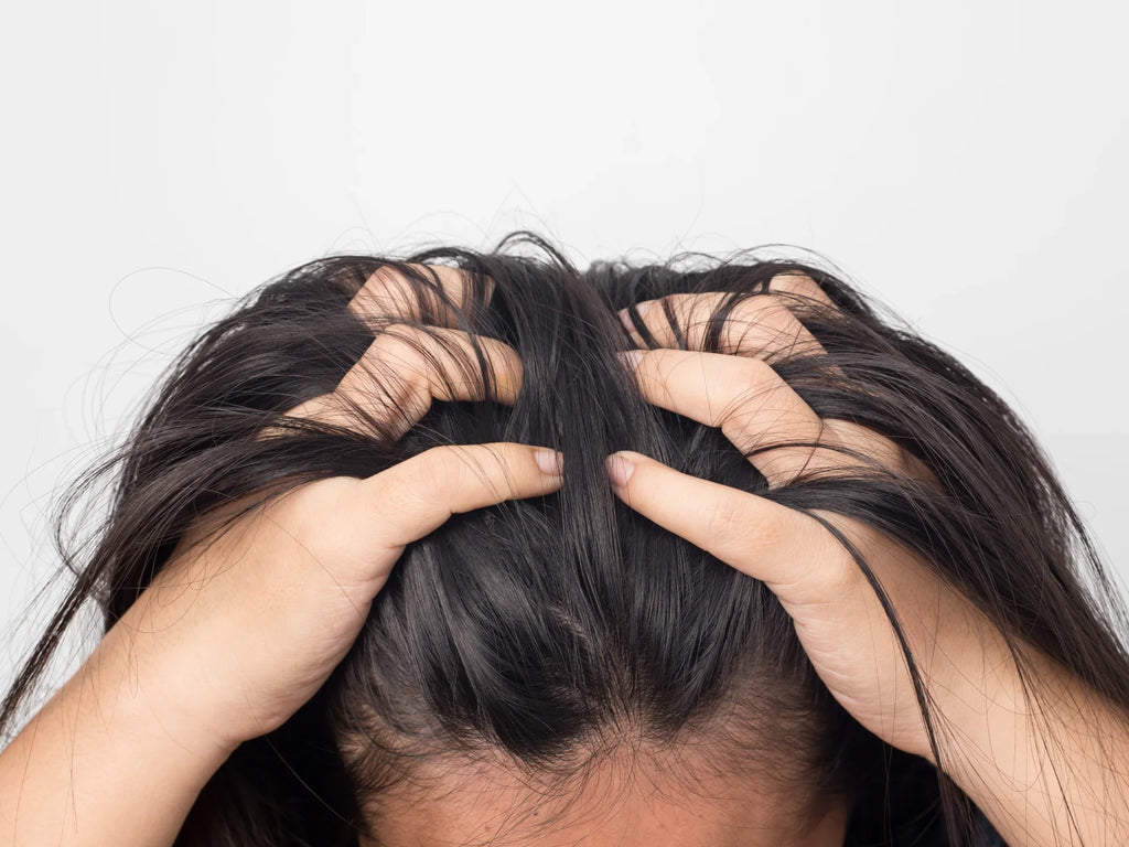 Ini Hal yang Perlu Diketahui dari Psoriasis Kulit Kepala