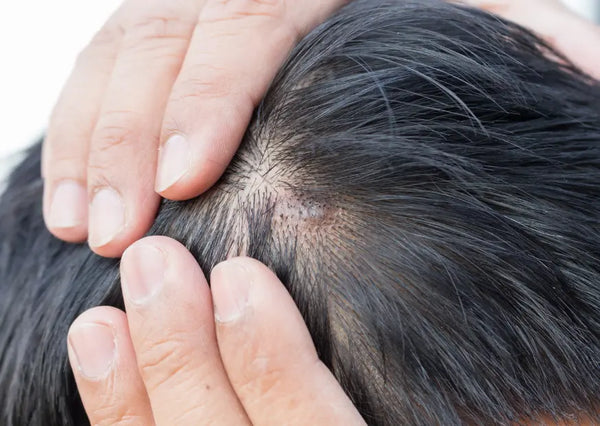 Kulit Kepala Berkerak: Penyebab dan Cara Mengatasinya