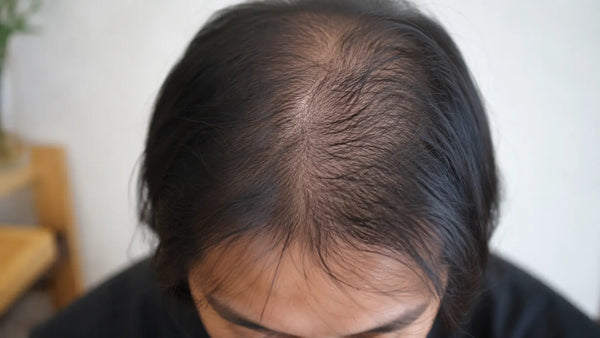 Rambut Tipis vs Rambut Rontok