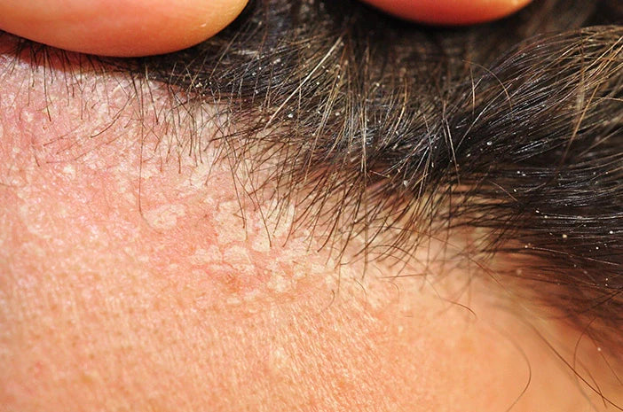 Shampo untuk Dermatitis Seboroik: Cara Pilih yang Tepat