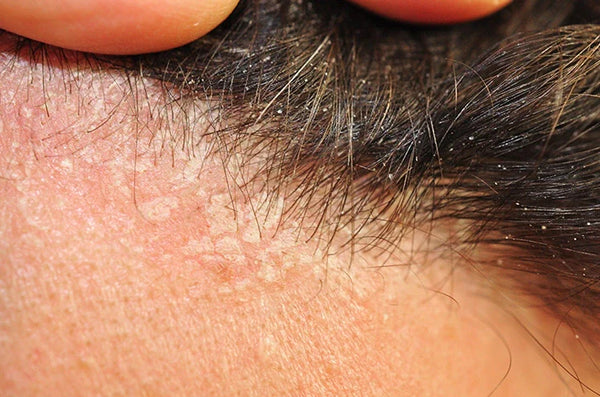 Shampo untuk Dermatitis Seboroik: Cara Pilih yang Tepat