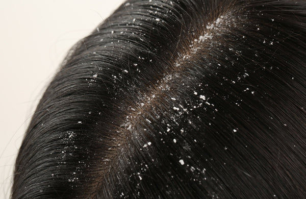 Shampoo untuk Mengatasi Masalah Rambut Rontok dan Ketombe dengan Cepat