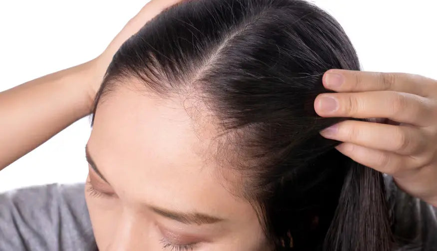 Cara Menumbuhkan Rambut Botak di Jidat