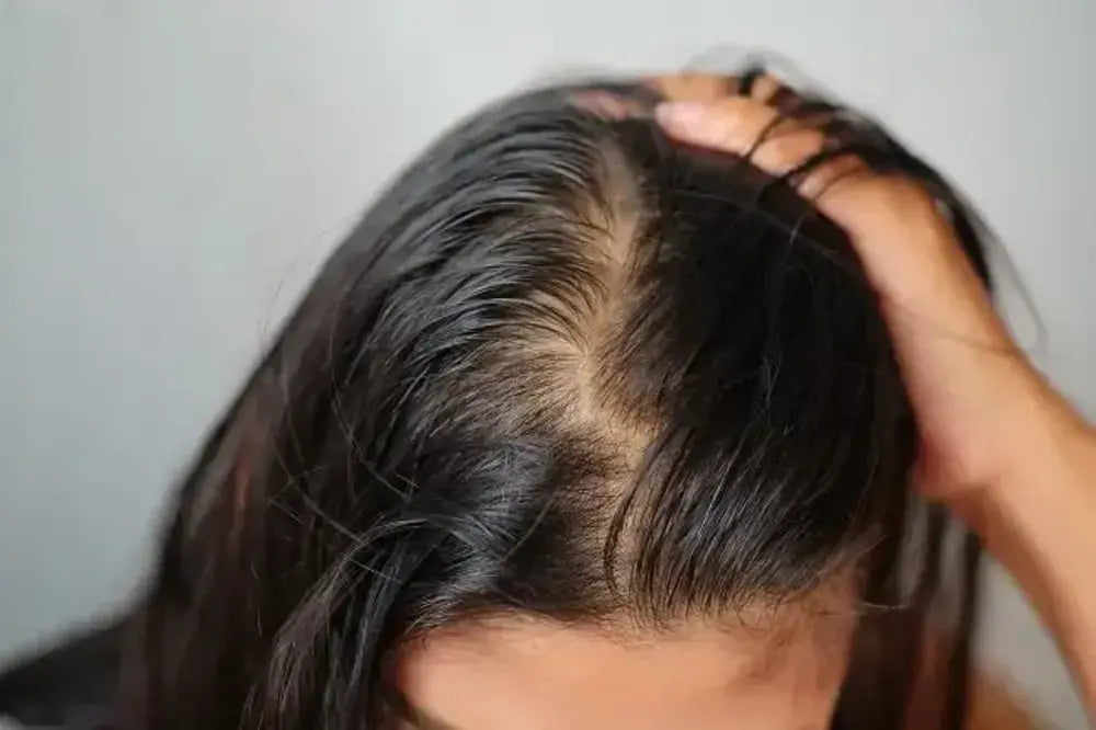 Penyebab Rambut Pitak: Kenali Faktor dan Cara Mengatasinya