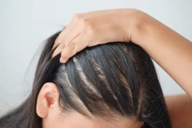 Mengenal Apa Itu Alopecia Areata, Ciri-Ciri, dan Penyebabnya