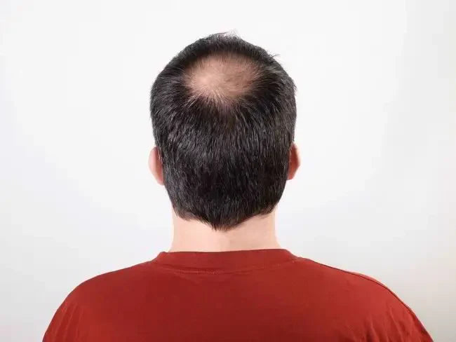 Berapa Lama Rambut Botak Tumbuh? Ini yang Perlu Kamu Ketahui!