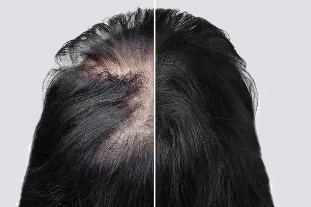 Berapa Lama Rambut Tumbuh? Ini Tipsnya Supaya Cepat Tumbuh!