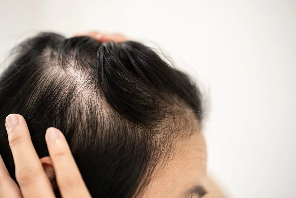 Bahan Alami Penumbuh Rambut Botak yang Cepat dan Ampuh