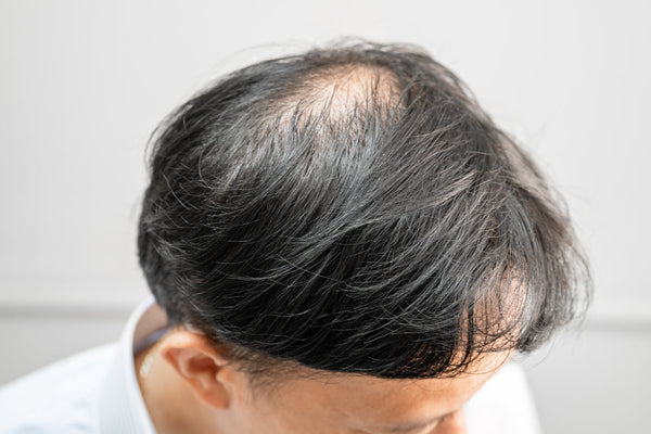 Cara Mengatasi Rambut Pitak: Penyebab, Solusi, dan Perawatan Efektif