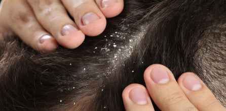 Tips Ampuh Cara Mengatasi Ketombe Kering pada Kulit Kepala