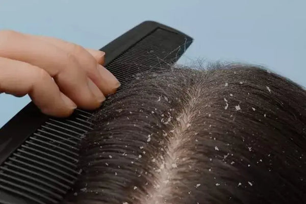 Ketombe merupakan masalah rambut yang umum terjadi, tapi ketika ukuran ketombe mulai membesar, ini bisa menjadi tanda bahwa kondisi kulit kepala sedang tidak sehat.