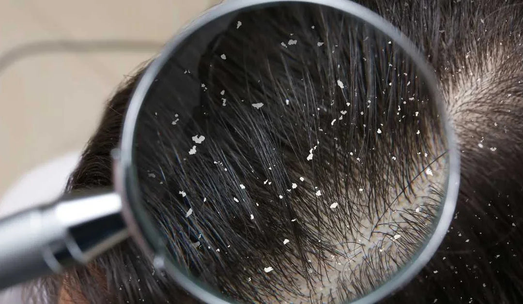 Akibat Ketombe Berlebihan dan Dampaknya bagi Kesehatan Rambut