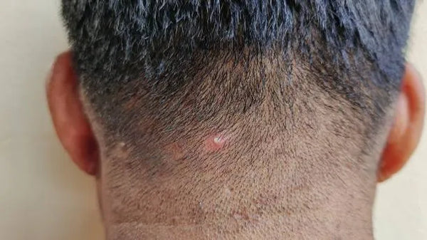 Benjolan Seperti Jerawat di Kulit Kepala: Penyebab, Cara Mengatasi, dan Rekomendasi Produk