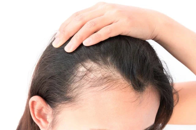 Cara Cepat Menumbuhkan Rambut Botak dalam 1 Minggu: Mungkinkah?