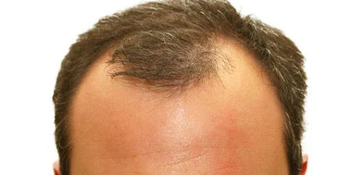 Apa Itu Rambut Botak M dan Bagaimana Mengenalinya