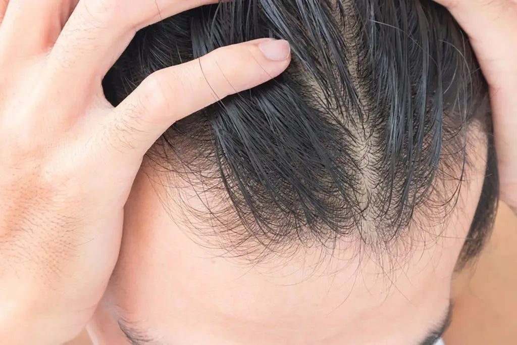 Mengatasi Rambut Lepek Akibat Minyak Berlebih di Kulit Kepala