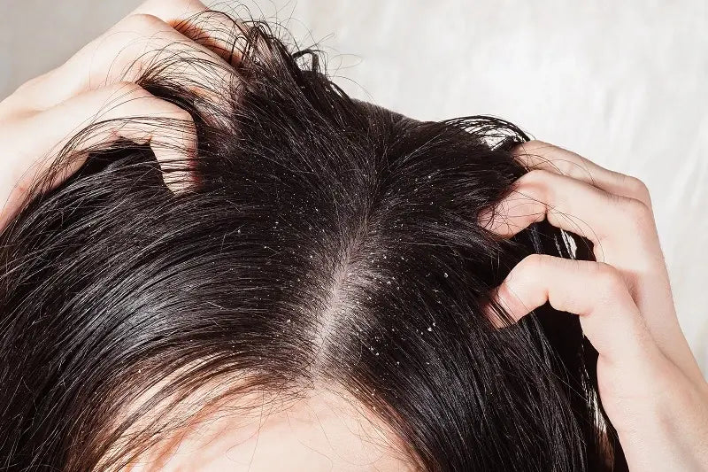 Akibat Rambut Berketombe: Dampak dan Cara Mengatasinya