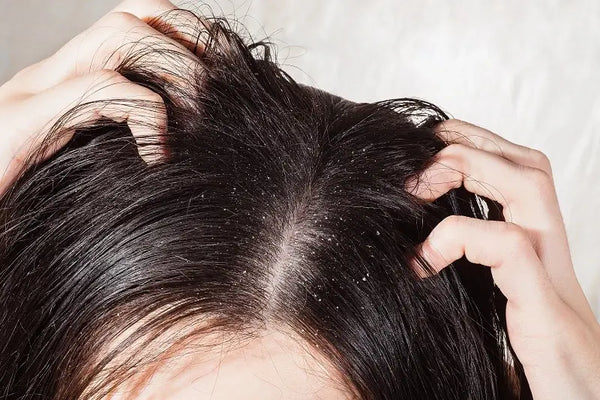 Akibat Rambut Berketombe: Dampak dan Cara Mengatasinya